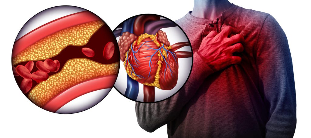 tomografia-corazón-ataques-cardiacos